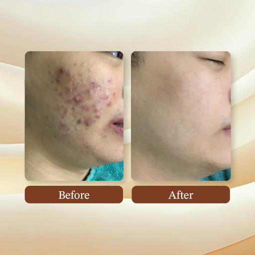 Acne Treatment