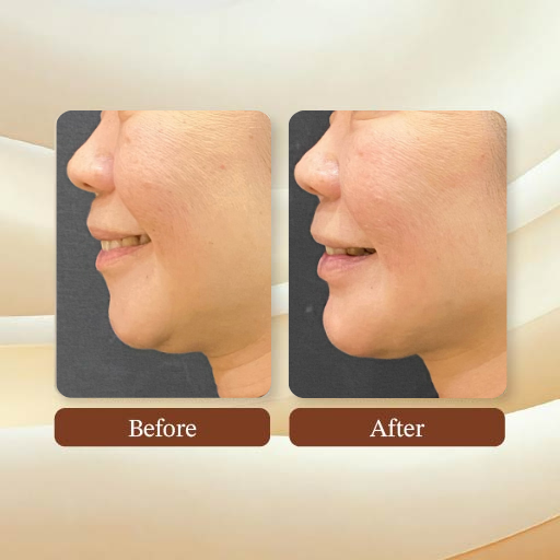 Face Lift Treatment