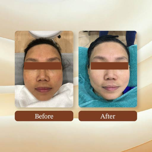 Laser Treatment