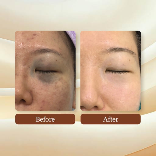 Laser Treatment