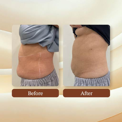 Slimming Treatment