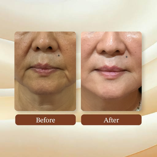 Face Facelift